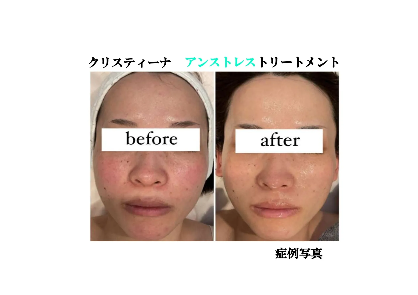 アンストレストリートメント
